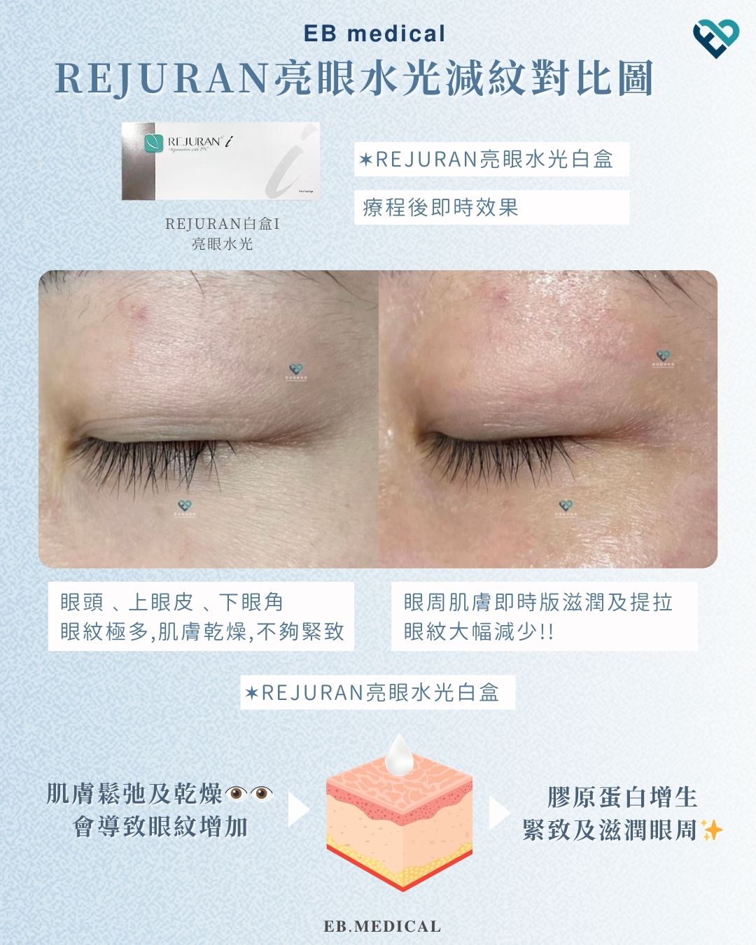 【水光針】REJURAN白盒
