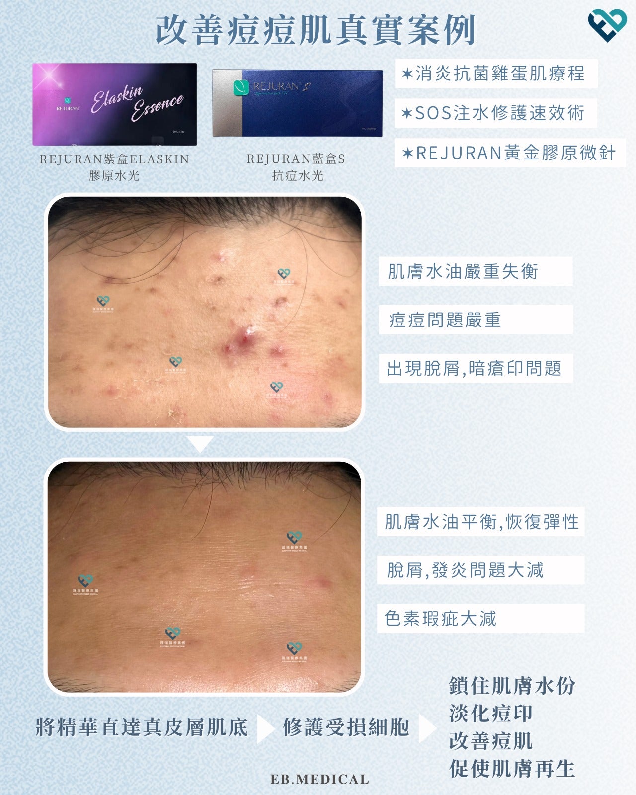 【水光針】REJURAN藍盒