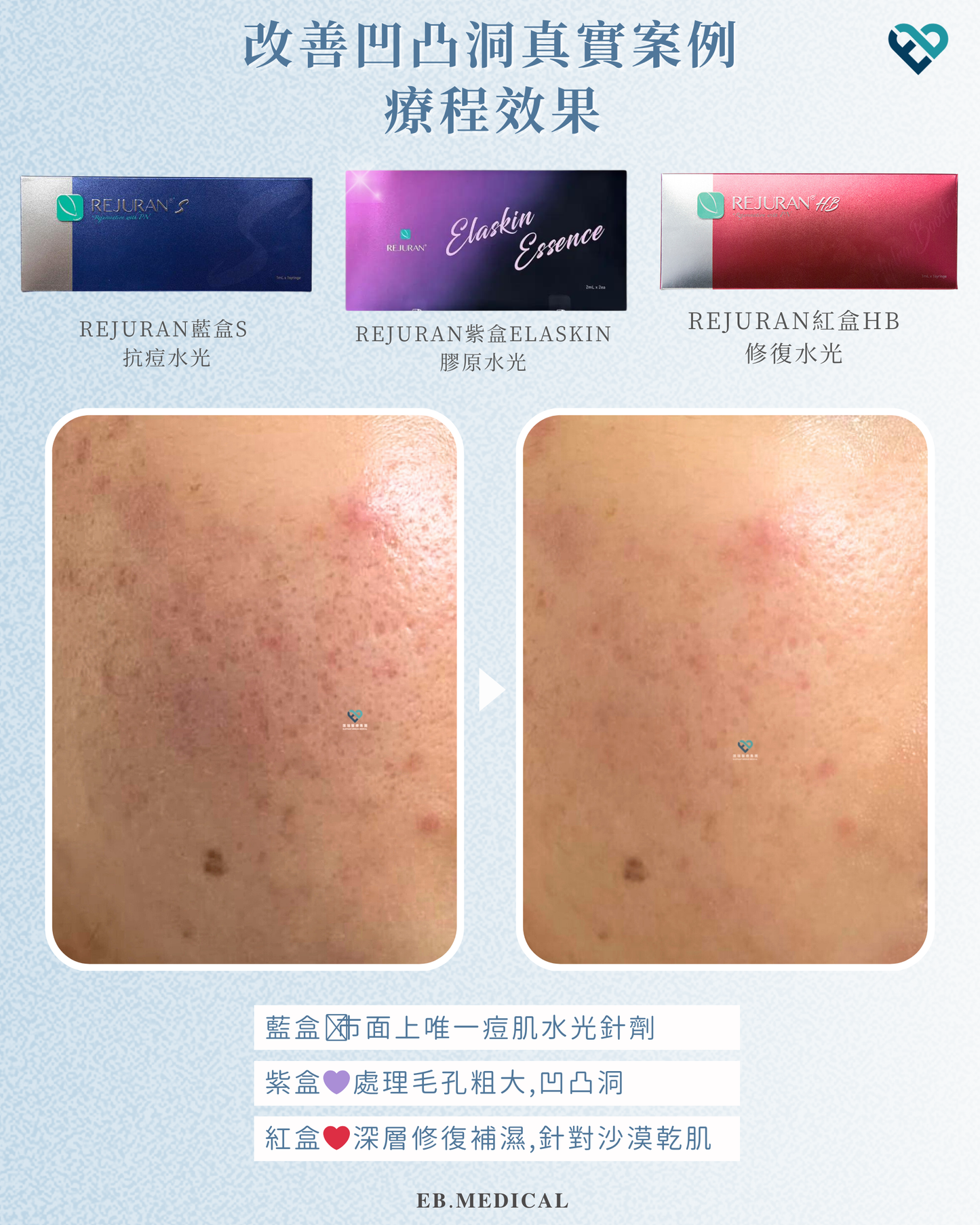 【水光針】REJURAN藍盒