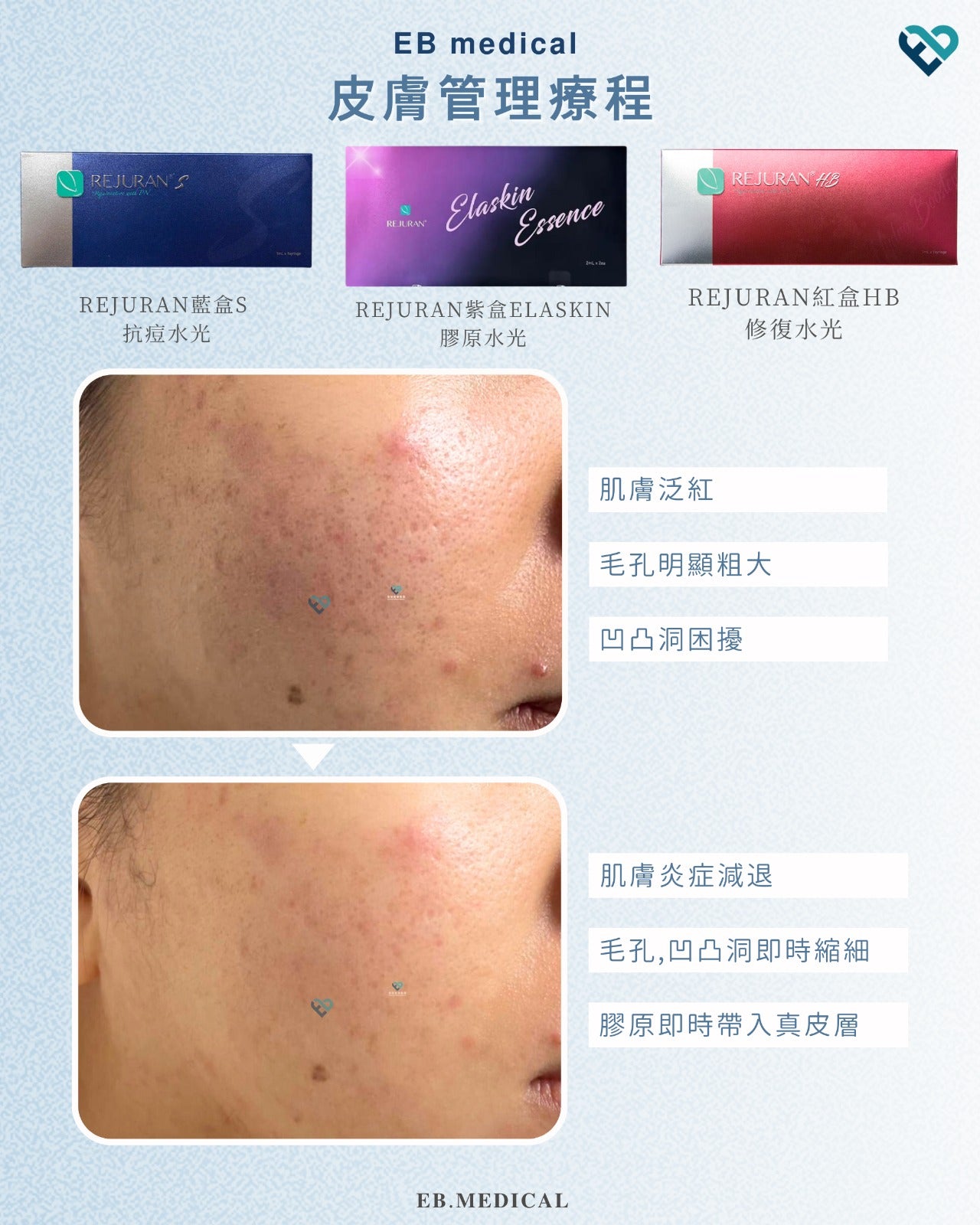 【水光針】REJURAN藍盒