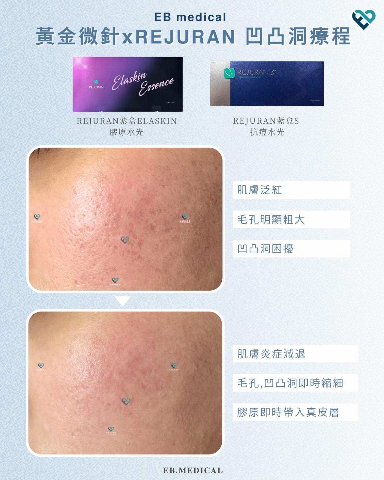 【水光針】REJURAN紫盒