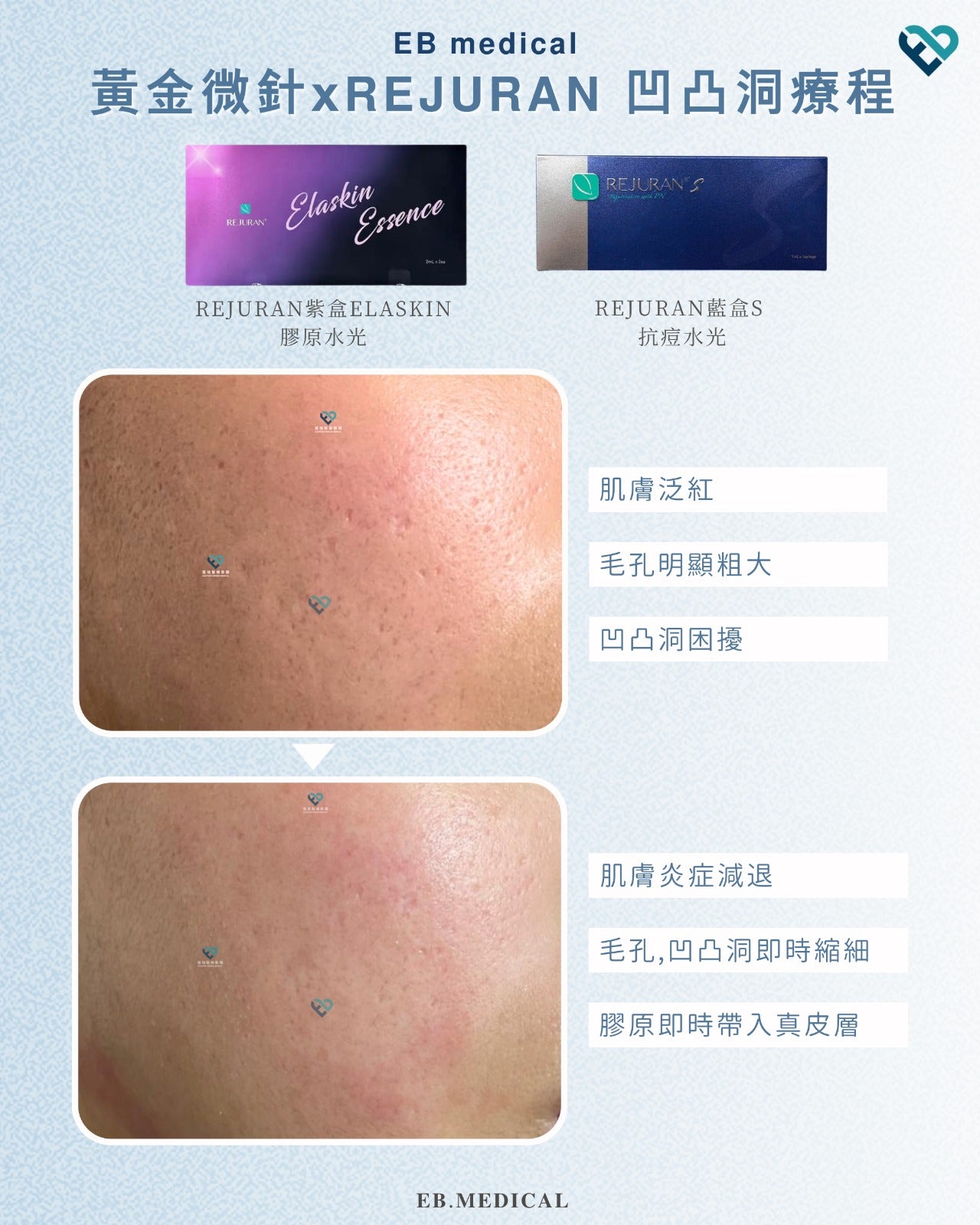 【水光針】REJURAN藍盒