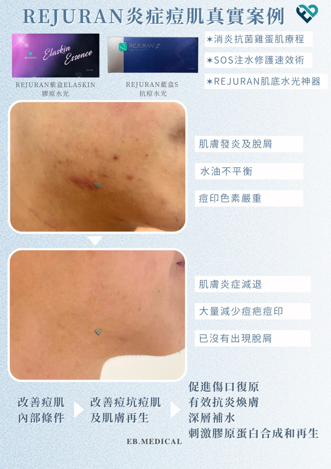 【水光針】REJURAN紫盒